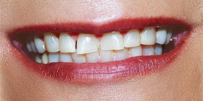 teeth before full mouth rehabilitation