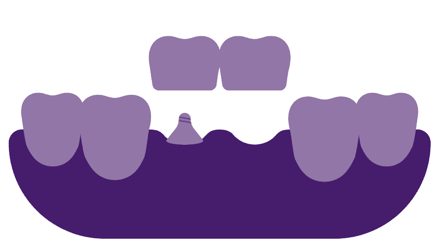 cantilever dental bridge