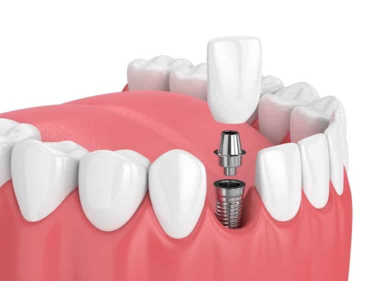 longmont dental implants