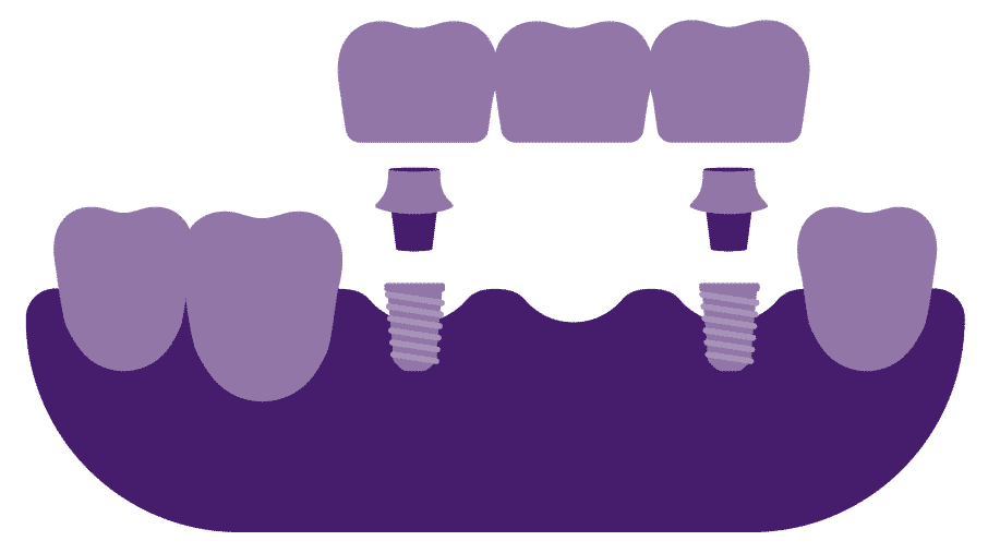 implant supported dental bridge