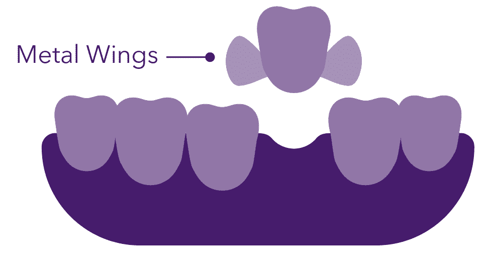maryland dental bridge