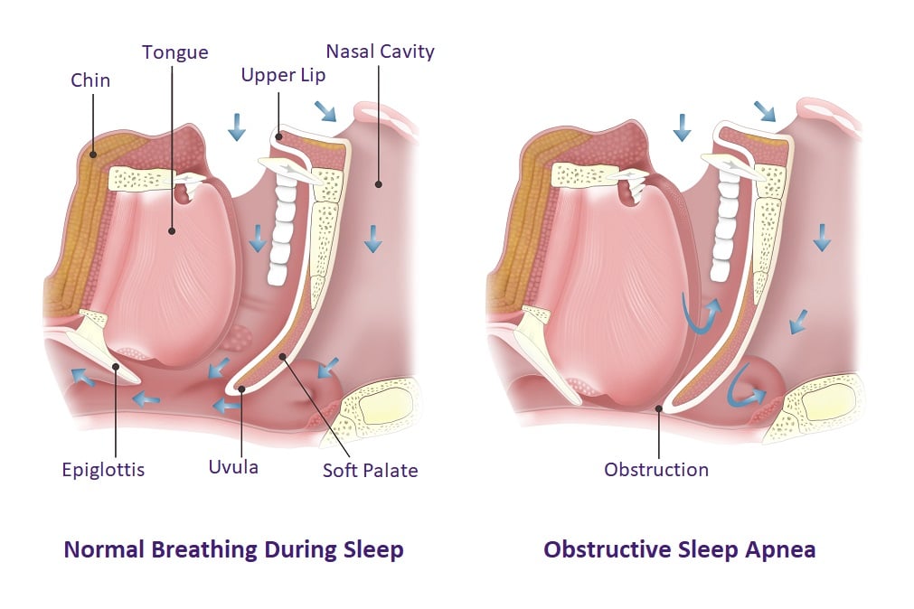 The Dangers of Uncontrolled Sleep Apnea