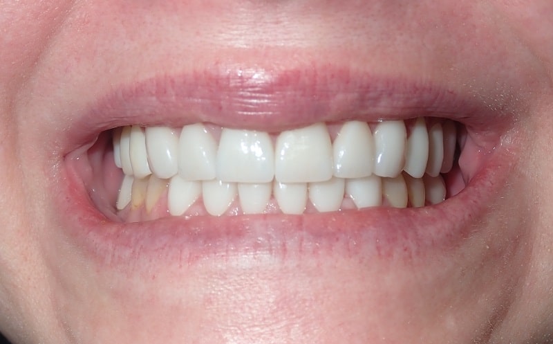 smile after dental crowns