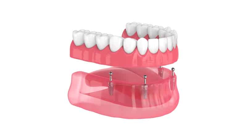 rendering of all-on4 implant retained dentures
