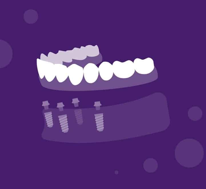 rendering of all-on-4 full arch dental implants