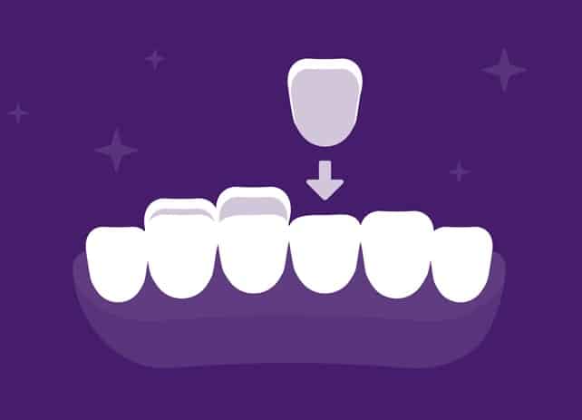 rendering of dental veneers