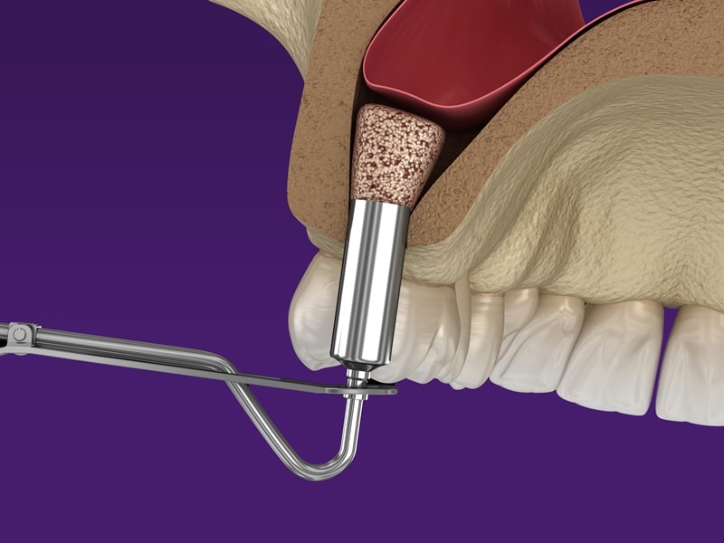 rendering of sinus lift surgery being performed