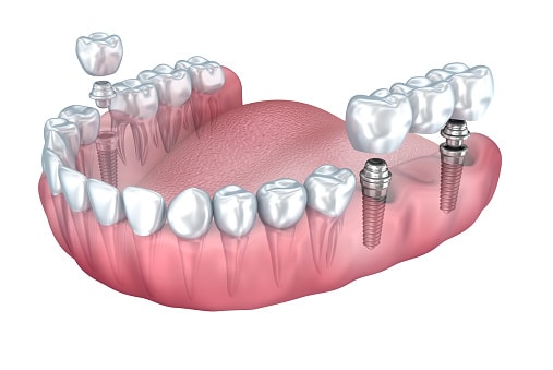 Multiple dental implants rendering