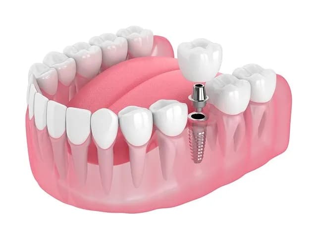 Single Dental Implant