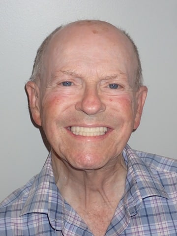 After picture of an All-on-X patient
