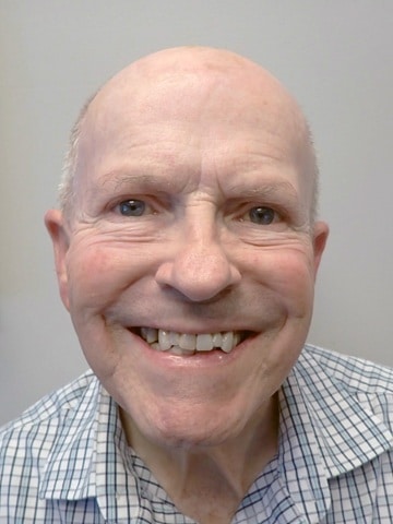 Before picture of an All-on-X patient