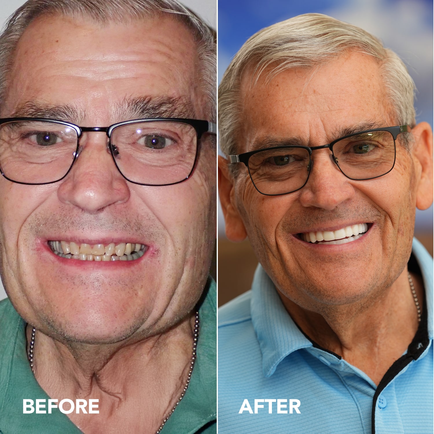 Before and after comparison of Lon’s smile after completing his All-on-X full-arch dental implant treatment at Longmont Dental Loft.