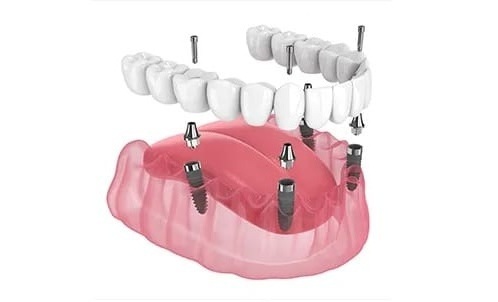 3D rendering of a screw-retained All-on-X full-arch dental implant, showing multiple titanium implants anchored in the jawbone supporting a fixed prosthetic bridge.