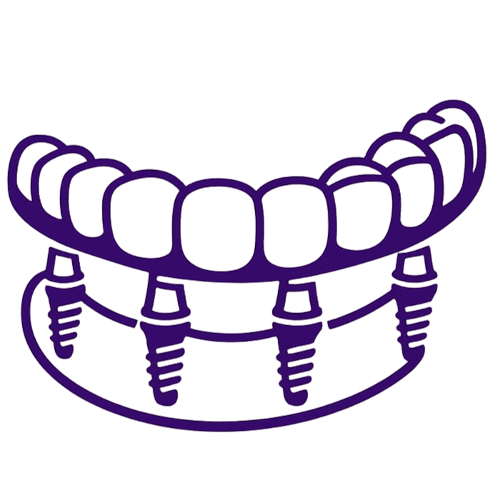 Full-arch dental implant restoration supported by implants