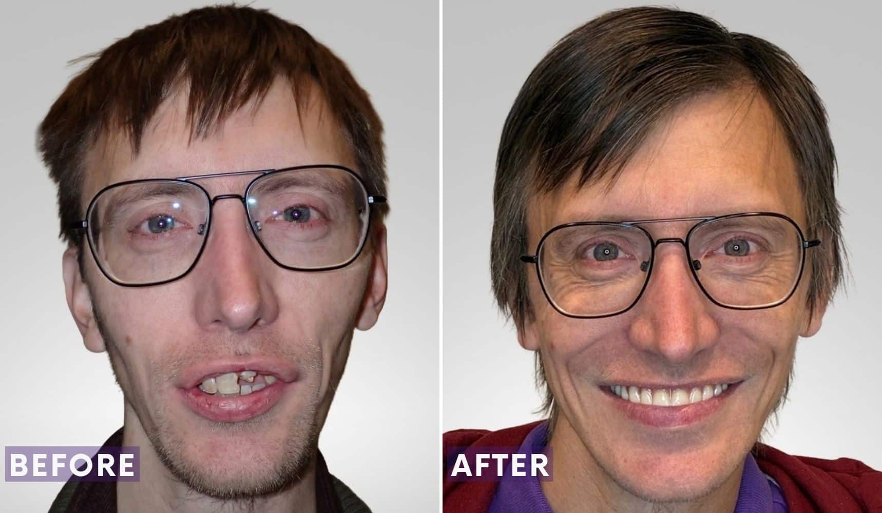 Before-and-after photos of Paul following oral surgery treatment